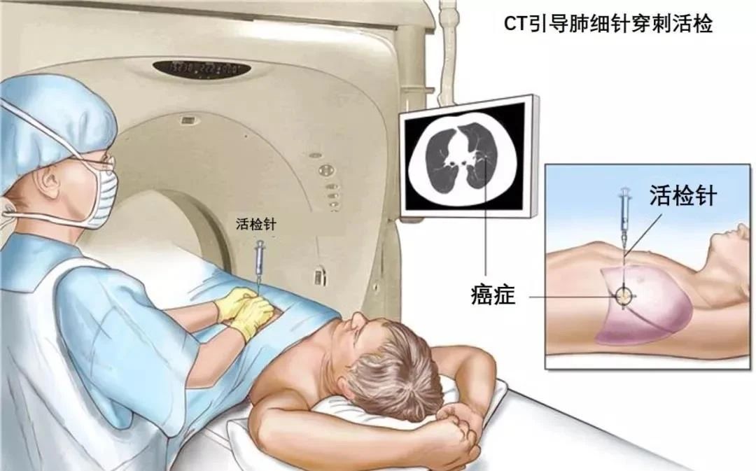 肺穿刺護理小貼士.jpg 肺穿刺護理小貼士.jpg